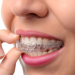 Beginning with Invisalign Treatment