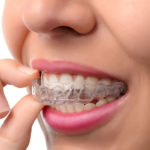 What to Consider When Beginning with Invisalign Treatment