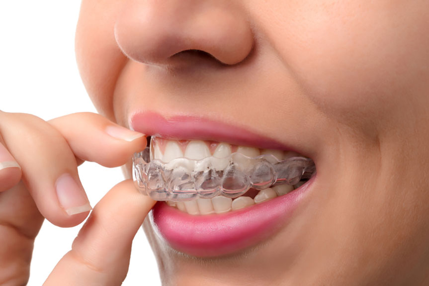 What to Consider When Beginning with Invisalign Treatment