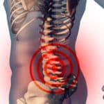 How to Slow Down Spinal Osteoarthritis